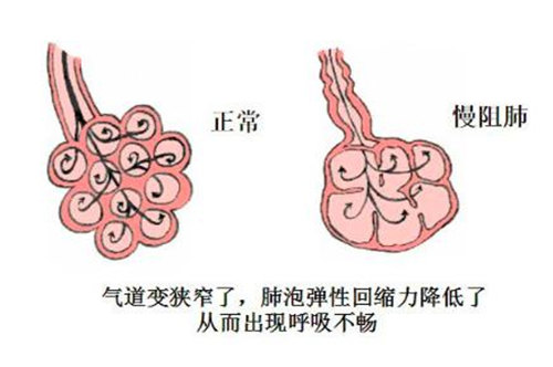 9月起 寶安這十個社區(qū)40歲以上居民免費查慢阻肺